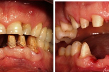 fig.2 rimozione ponte inferiore - fig.3 preparazione sup e inf