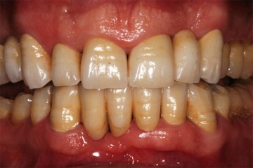 fig.4 corone in oro porcellana