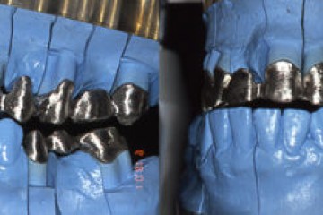 Fig.9.2   studio della dinamica masticatoria  dx e sn