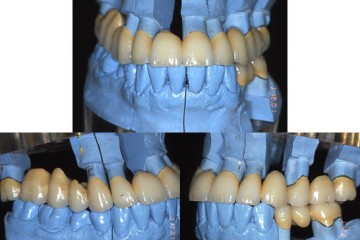 Fig. 10.1  Protesi definitive sui modelli da laboratorio