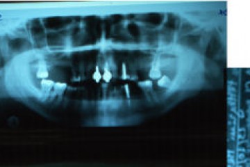 Fig. 3   RX ortopanoramica a A.T.M.