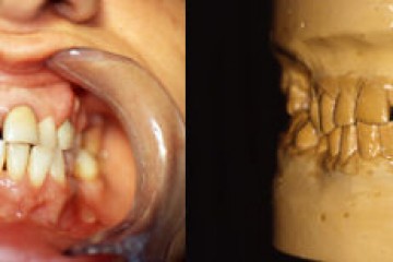 Fig.4   Visione frontale paziente e modelli studio