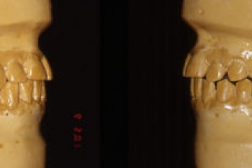 Fig.4.2   Visione frontale paziente e modelli studio