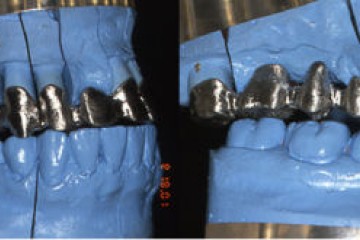 Fig.9.1   studio della dinamica masticatoria  dx e sn
