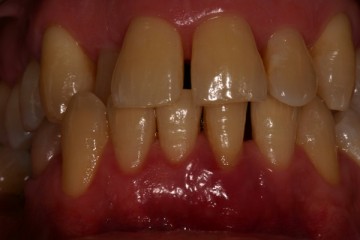 3.1 è il dente da estrarre