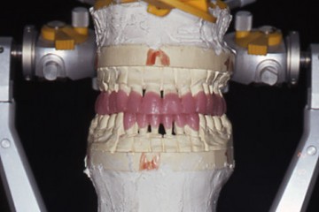 Figura 3 CERATURA DIAGNOSTICA IN ARTICOLATORE A VALORI INDIVIDUALI