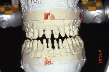 Figura 4 MODELLI MONTATI IN ARTICOLATORE (visione frontale)