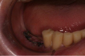 fig.4  sito implantare