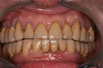 fig.6 Definitivi