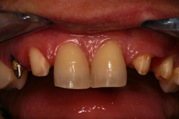 denti monconizzati